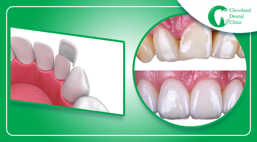 Top 4 cosmetic dentistry alternatives to veneers. Blog