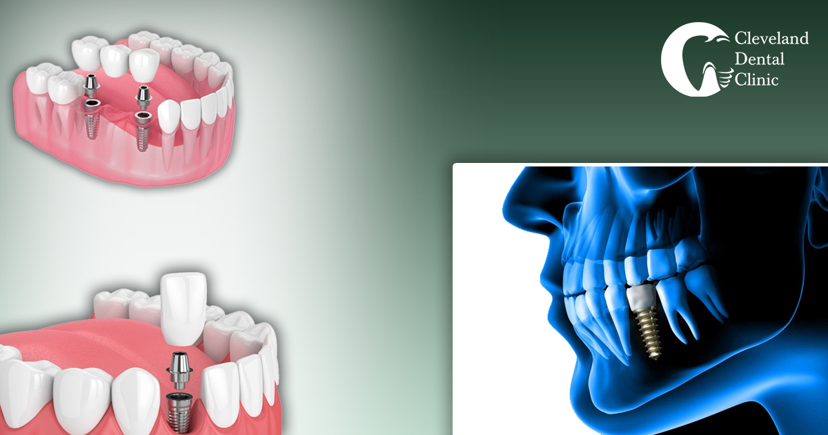 titanium-post-inserted-into-the-jawbone-serving-as-a-replacement-for-a-natural-tooth-root