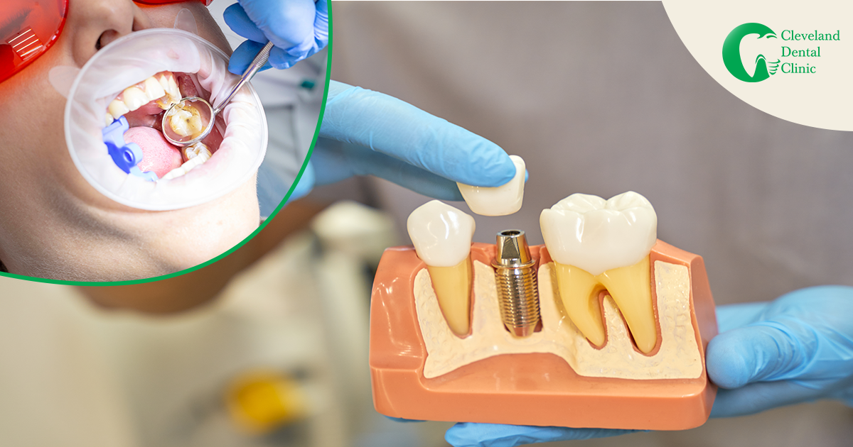 dental-restoration-treatment-on-loss-of-tooth