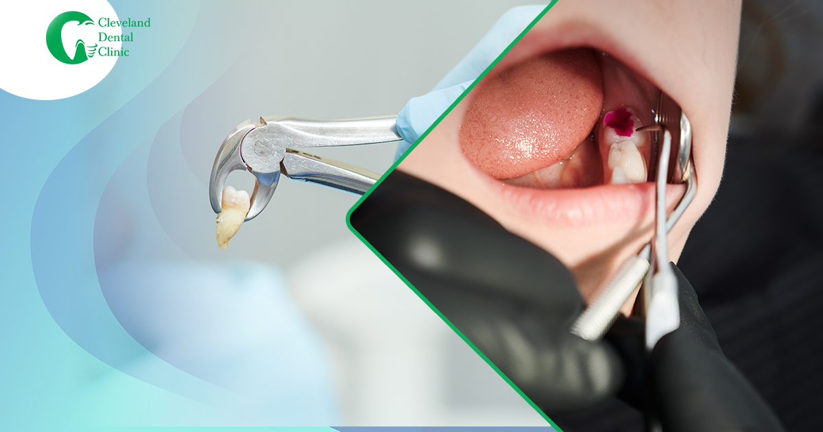 tooth-extraction-process-alongside-extracted-tooth